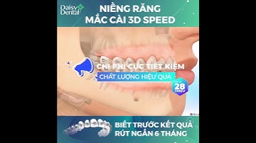 Niềng Răng Mắc Cài 3D Speed | Nha Khoa Daisy