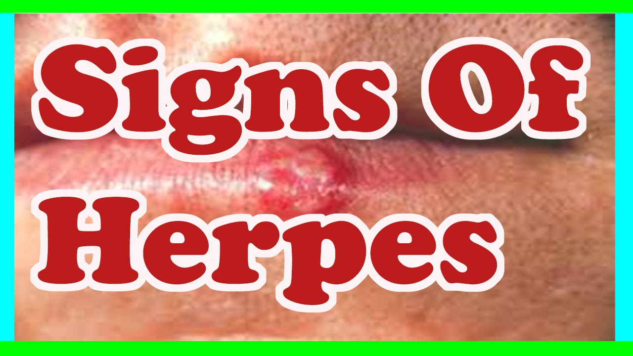 Signs Of Herpes Symptoms Of Herpes Youtube