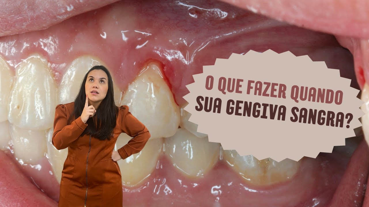 O que fazer quando sua gengiva sangra? - YouTube
