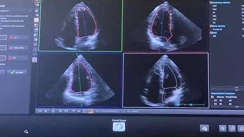EVALUATION OF 3D LEFT VENTRICULAR VOLUMES AT TRANSTHORACIC ECHOCARDIOGRAPHY (TTE)