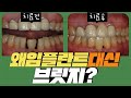 치과마다 치료계획이 다른이유 II-왜 임플란트 대신 브릿지?