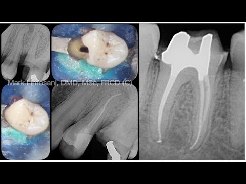 dr.-mark-a.-limosani-minimally-invasive-endodontics-amed-2017