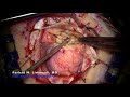 Surgery for resection of brain tumor.  Large metastatic brain tumor. Keyhole Approach!