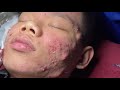 Blackheads  milia big cystic acne blackheads extraction whiteheads removal pimple popping 001