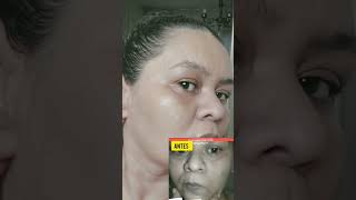 Como se livrar da melasmaolha esse antes e depois ? skincare pelelinda melasma bepantol pele