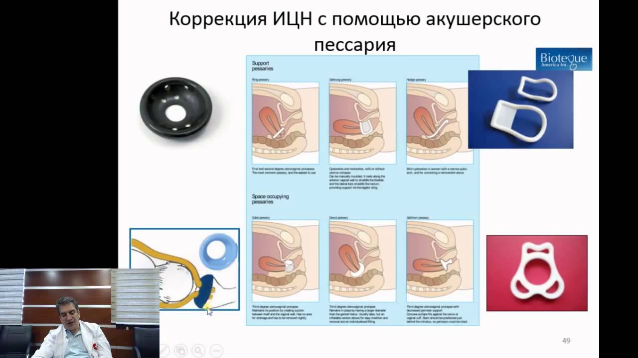 Как ставят пессарий при беременности. Акушерский пессарий 2. Методика постановки акушерского пессария. Акушерский разгружающий пессарий 1.