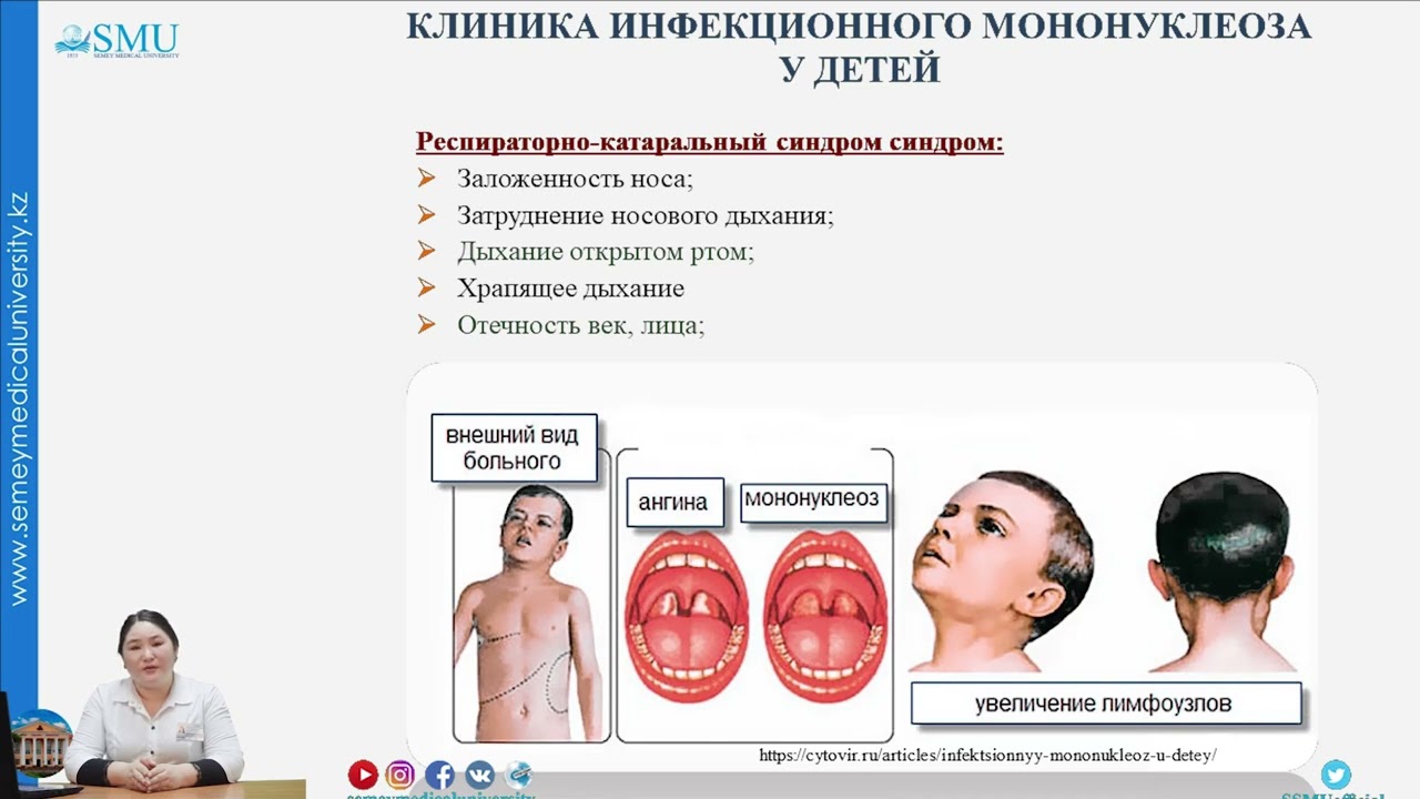 Инфекционный мононуклеоз у детей