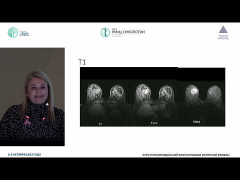 Трижды негативный молекулярный подтип рака молочной железы