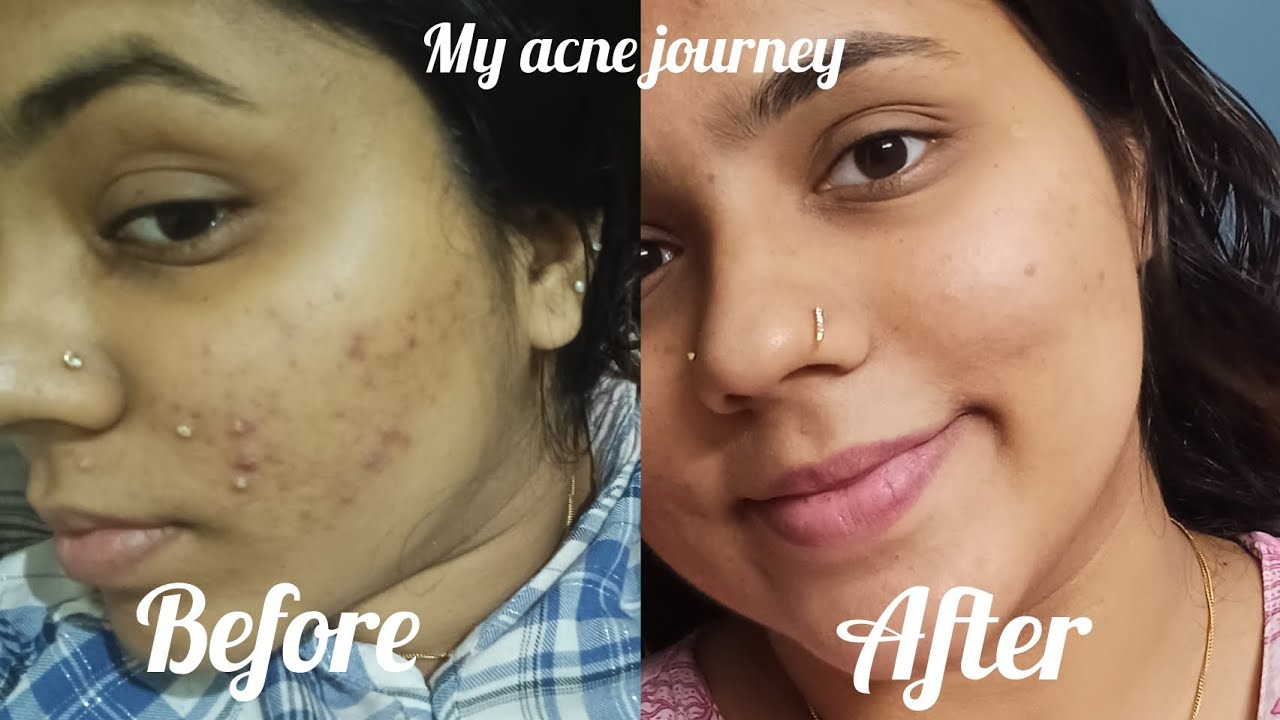 How I got rid of my acne *1 product that changed my life*💕🤗 #acne # ...