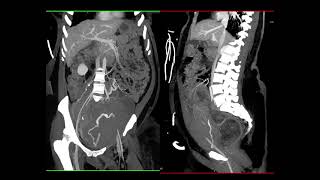 CT of the Acute Abdomen: GU Applications Part 3