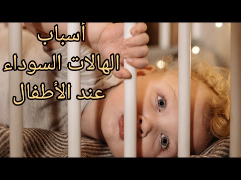 أسباب الهالات السوداء عند الأطفال