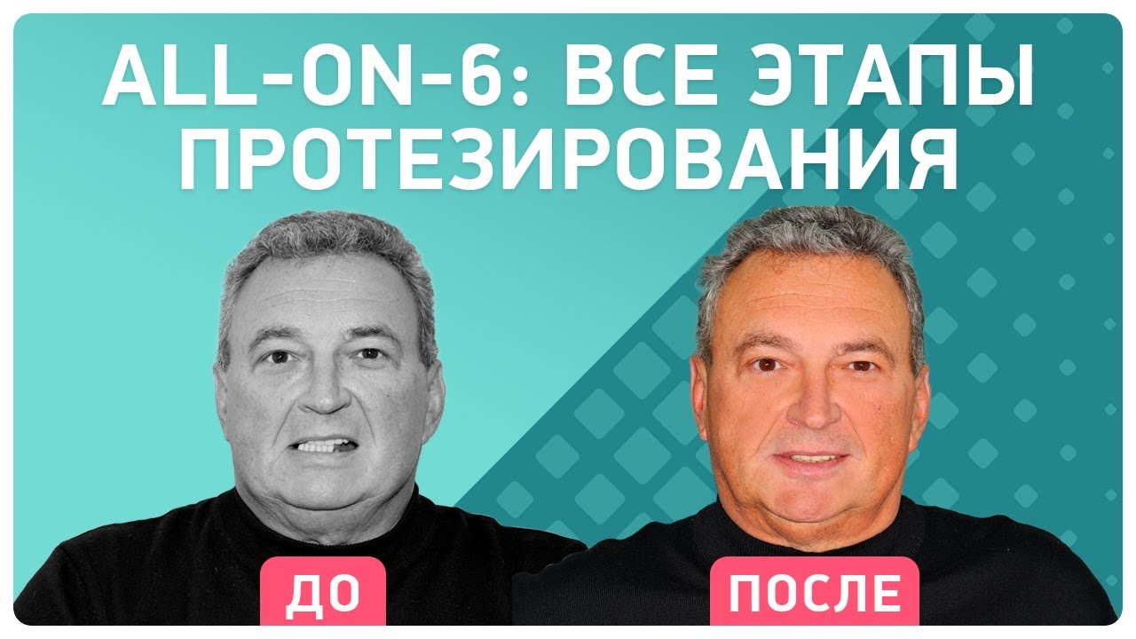 Имплантация all-on-6 и протез СРАЗУ 👉 подробный репортаж ДО и ПОСЛЕ лечения в клинике Smile-at-Once