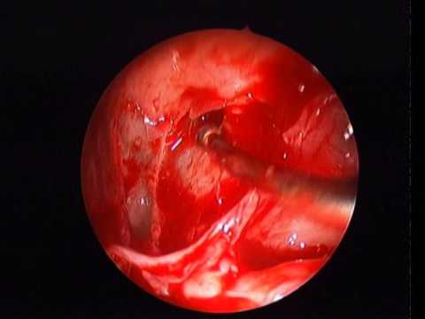 FRONTAL TREFINE FOR FRONTAL RECESS EXPLORATION WHICH IS A SURE,SECRE,SAFE AND SIMPLE TECHNIQUE