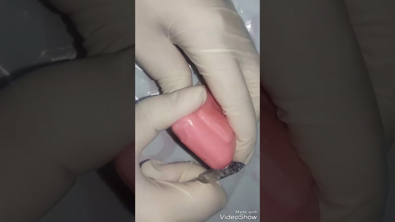 نحت رحى اولى سفلية