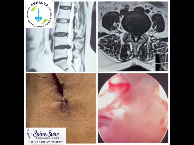 L45 Endoscopic Spine Surgery 85 #sciatica #backpain #hyderabad #endoscopicspinesurgery #discproblem