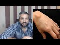 تعرف على الأكياس الزلالية وطرق علاجها وكيفية التخلص منها ( ganglion cyst)