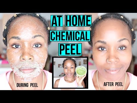 HOW TO Make a NATURAL Chemical Peel AT HOME | ERASE ACNE, WRINKLES & DARK SPOTS