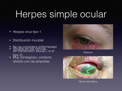 Vídeo: Herpes Ocular: Síntomas, Tratamiento Y Más