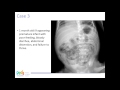 Approach to Pediatric Abdominal X-rays