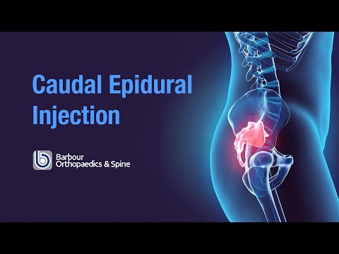 What is a Caudal Epidural injection?