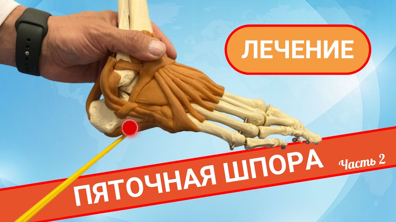 КАК ЛЕЧИТЬ ПЯТОЧНУЮ ШПОРУ? (Часть 2) - YouTube