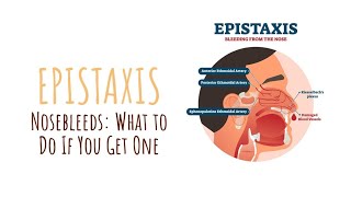 #epistaxis Nosebleeds: What to Do If You Get One