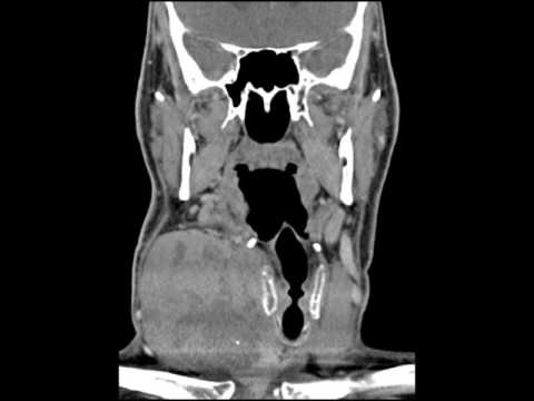 Anaplastic Thyroid Carcinoma