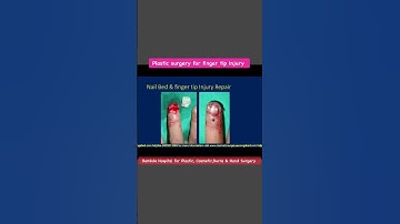 Finger tip amputations & Nail bed injury repair with plastic surgery @Ramakantbembdecosmeticsurgeon