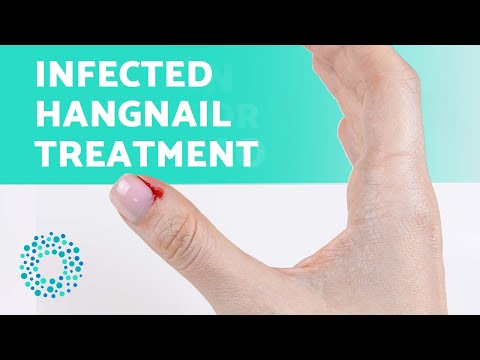 Video: Jak zacházet s infekcí Hangnail (a předcházet vzniku nových)