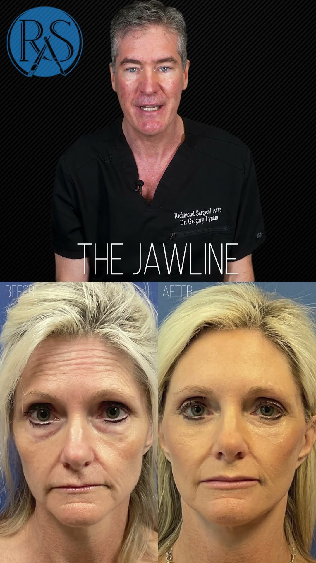 Deep plane facelift, a deep dive