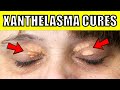 How to Get Rid of Cholesterol Deposits Under the Eyes Naturally (Xanthelasma Removal at Home)