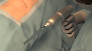 Advancing Powered Surgical Tool Performance with Bal Seal Spring-Energized Seals by BalSealEngineering 377 views 6 years ago 2 minutes, 10 seconds