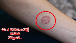 Top 4 Causes of Tinea (Thamara) | Permanent Solutions to Prevent and Cure | Inform clinics