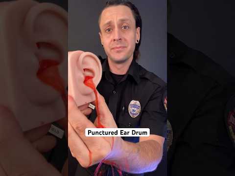 Punctured ear drum? Try this… #survival #medical #health