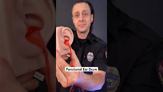 Punctured ear drum? Try this… #survival #medical #health