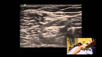 LSORA: US guided Popliteal Sciatic Regional Anaesthesia block
