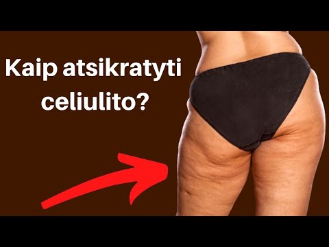 Video: Kaip Atsikratyti Celiulito