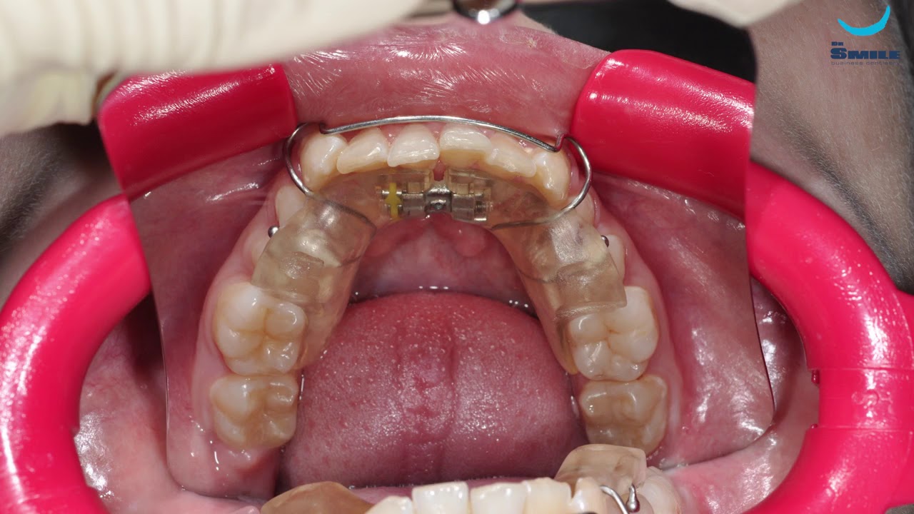 Установка брекет системы. Врач Догару А. М. dr Smile YouTube