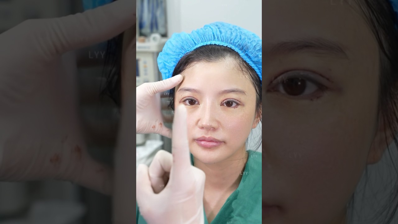 双眼皮修复#Tatcha #blepharoplasty #eyelidsurgery #fyp