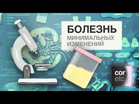 Болезнь минимальных изменений. Нефротический синдром.