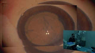 Avegant Glyph /Ngenuity 3D and pig eye , corneal incisions and capsulorhexis Lukan Mishev Live