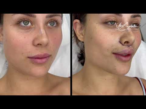 LIP LIFT SURGERY BEFORE - AFTER / OP. DR. YCEL SARIALTIN