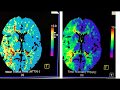 Video 1 of 3:  How to interpret a Brain CT Perfusion Scan for acute stroke