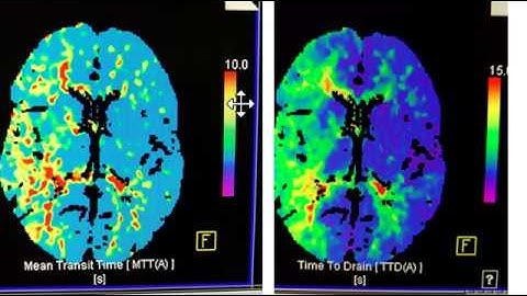 Video 1 of 3:  How to interpret a Brain CT Perfusion Scan for acute stroke
