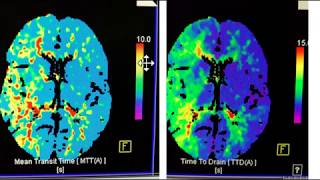 Video 1 of 3:  How to interpret a Brain CT Perfusion Scan for acute stroke