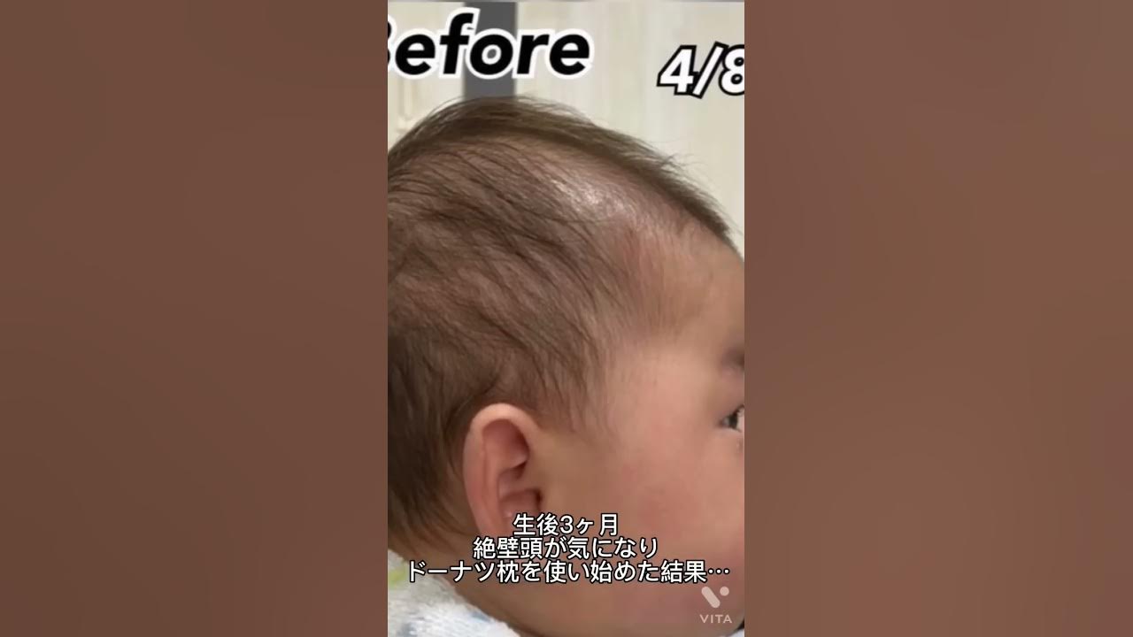 絶壁頭だった赤ちゃんに1ヶ月半ドーナツ枕を使ってみた エスメラルダ ドーナツ枕 インサート枕 絶壁 絶壁頭 斜頭症 頭の形 頭の悩み Youtube