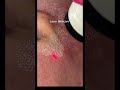 Laser Skincare Shorts Shortvideo Laser Skincare Shorts Shortvideo