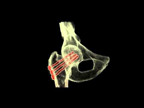 Перелом шейки бедренной