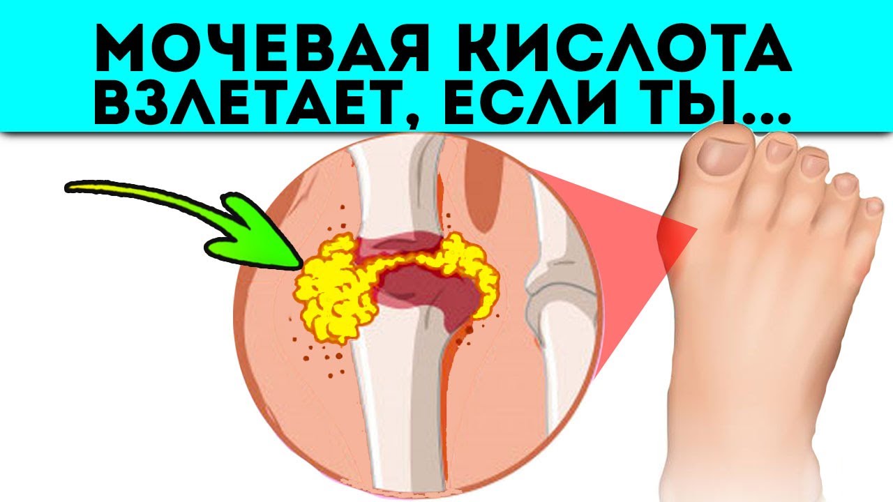Предотврати на раз-два! Смотри, мочевая кислота взлетает, если ты ...