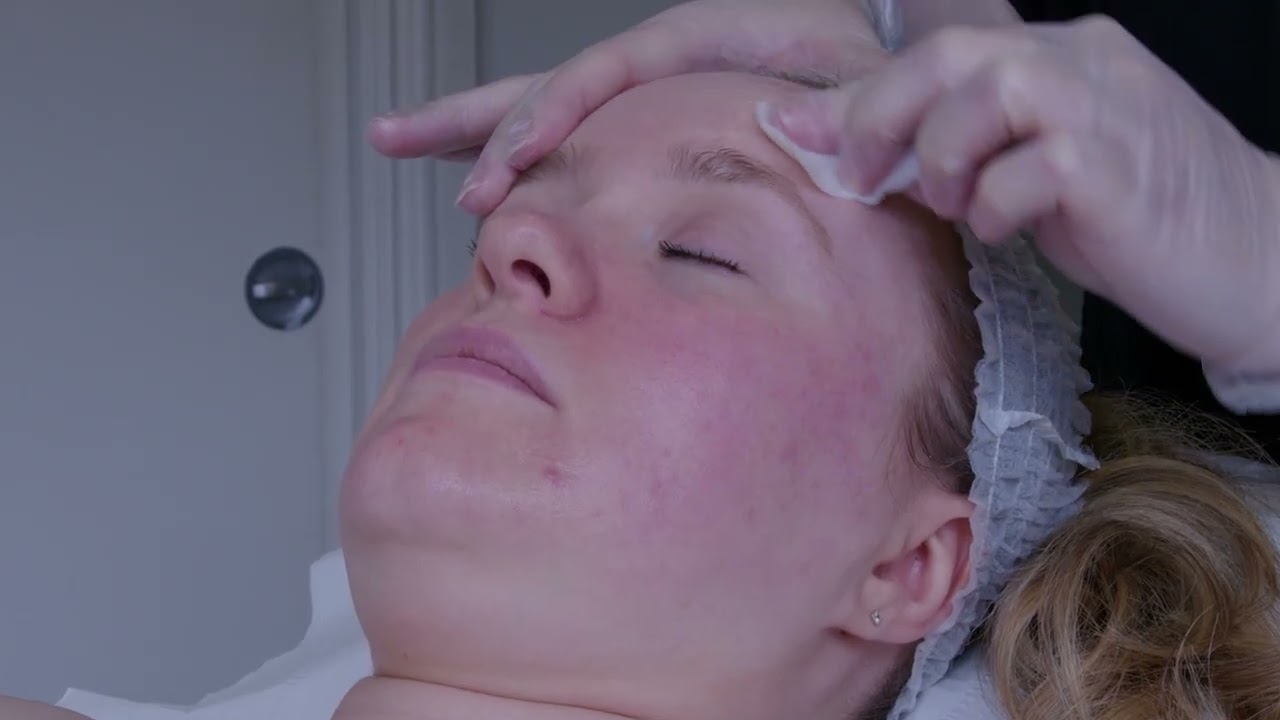 Microdermabrasion Treatment | Eden Skin Clinic Treatments